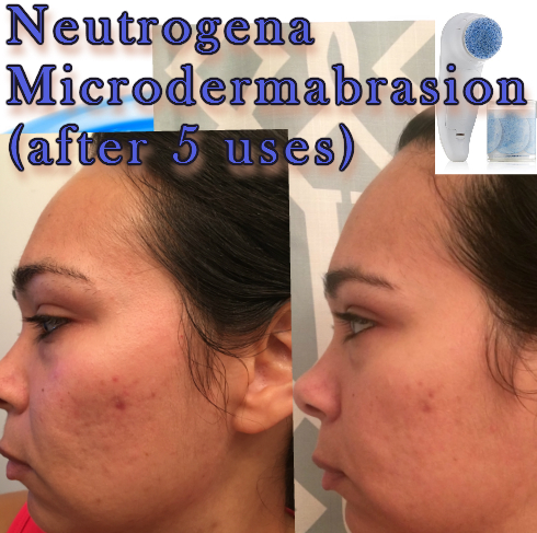 Neutrogena Microdermabrasion How to Use & Review