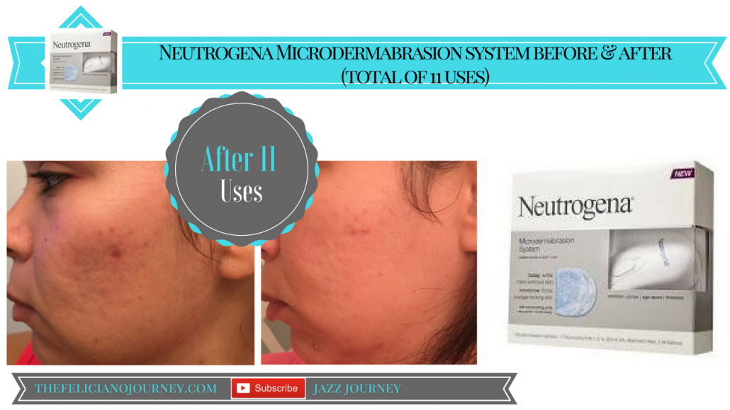 Neutrogena Microdermabrasion Review (After 11 uses)