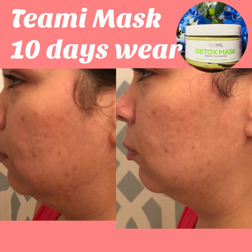 Teami Detox Mask Review On Sensitive Skin Before After